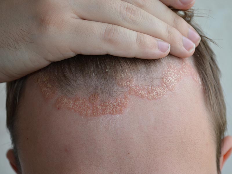 Psoriasis - Symptoms - NHS