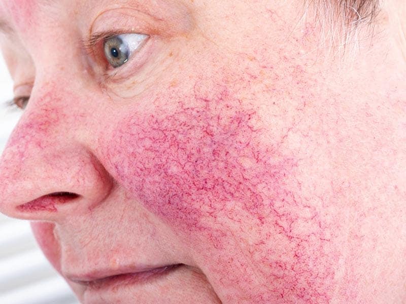 Rosacea Everything Skin Clinic