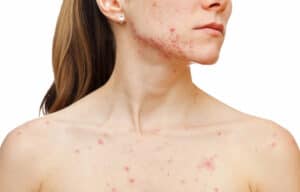 eczema specialist manchester