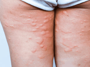 Hives dermatologist Advice