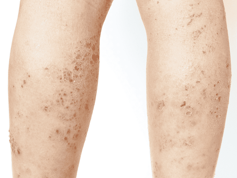 Lichen Planus: What It Is, Causes, Types & Treatments