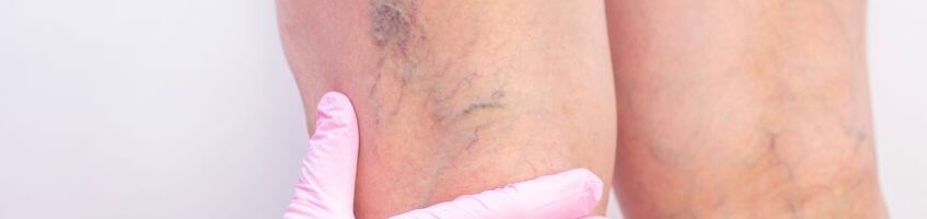 Varicose Vein Removal Manchester, Laser