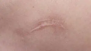 Keloid Scars