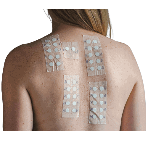 Skin Allergy Patch Test in Manchester