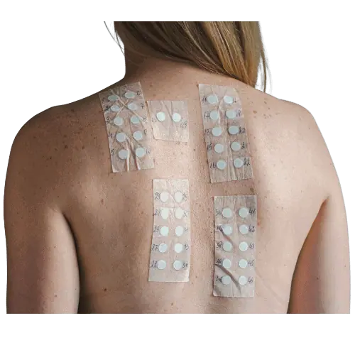 Skin Allergy Patch Test in Manchester