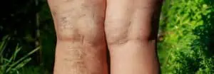 varicose veins