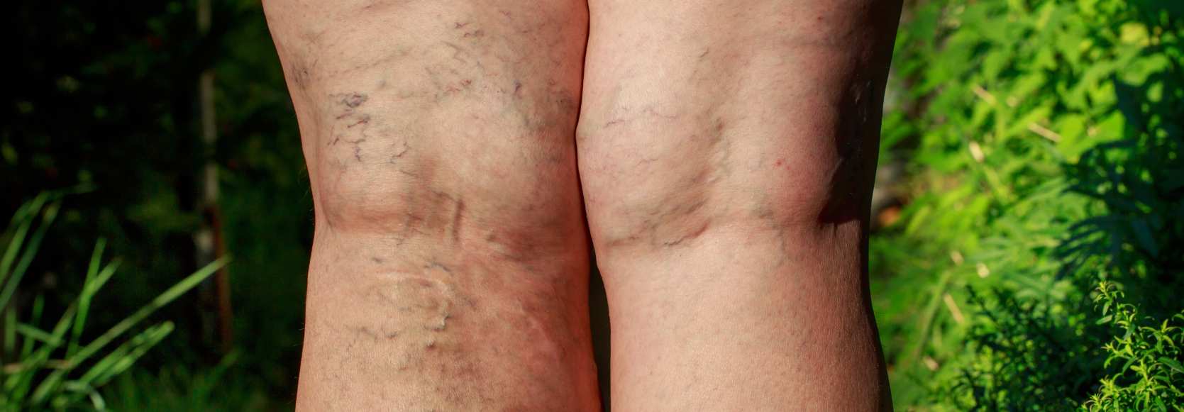 varicose veins