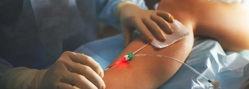 endovenous laser ablation evla treatment