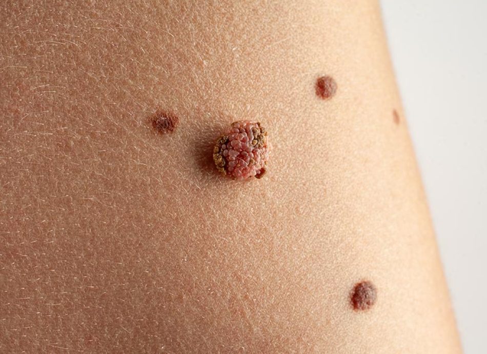 Malignant-melanoma-Large-6-1.jpg