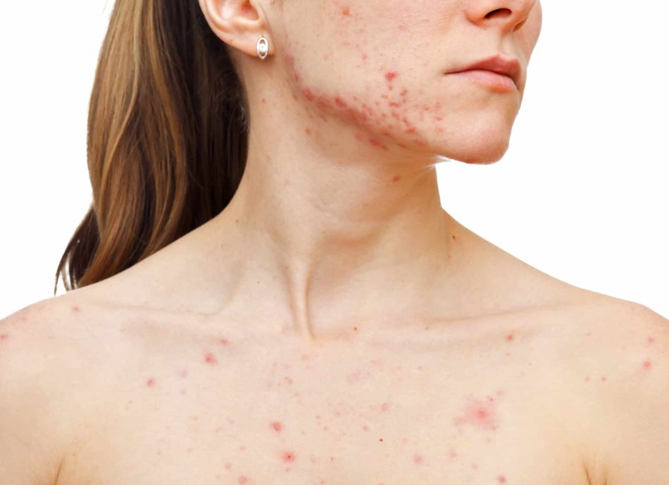 acne-scars-scaled-2.jpg