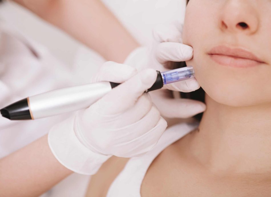 Microneedling Manchester