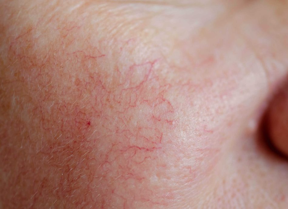 spider-veins-thread-vein-and-rosacea